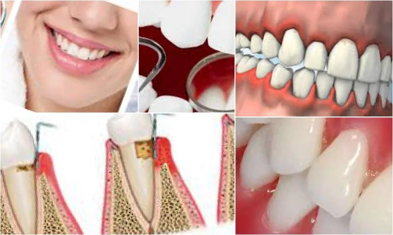 Periodontoloji İle Diş Eti Sorunlarından Kurtulun