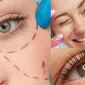 Alt Göz Kapağı Estetiği Sonrası Şişlik ve Morluk Olur Mu?